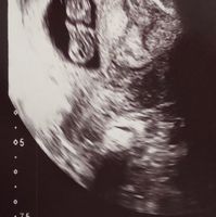 Ayuda con método ramzi: niño o niña? - 2