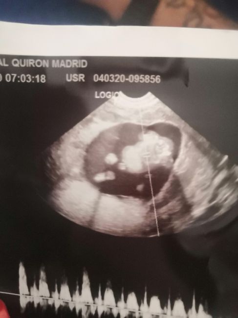 Ayuda con método ramzi: niño o niña? - 1
