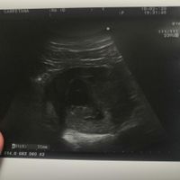 Ayuda con método ramzi: niño o niña? - 1