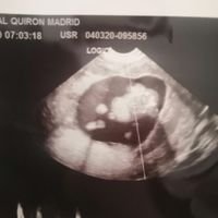 Ayuda con método ramzi: niño o niña? - 1