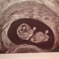 Ayuda con método ramzi: niño o niña? - 1