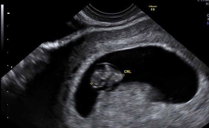 Ayuda con método ramzi: niño o niña? - 1