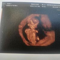 Ecografias primer trimestre: niña o niño? - 1