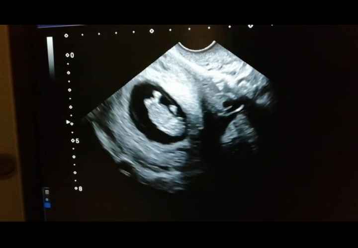 Ayuda con método ramzi: niño o niña? 14
