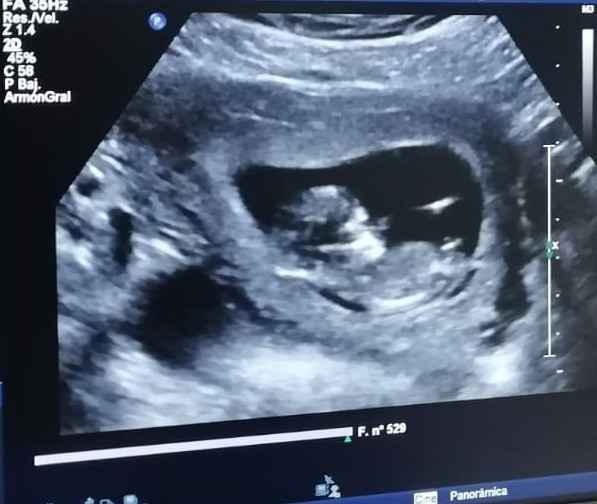 Ayuda con método ramzi: niño o niña? 13