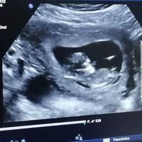 Ayuda con método ramzi: niño o niña? - 1