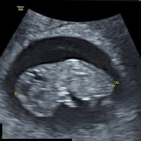 Ayuda con método ramzi: niño o niña? - 1
