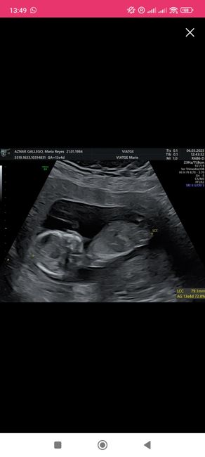 Alguien sabe identificar el sexo del bebe según el tubérculo? 2