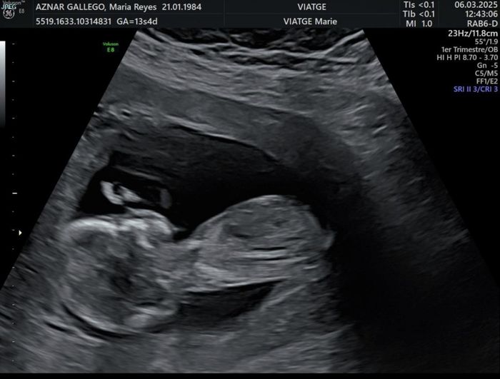 Alguien sabe identificar el sexo del bebe según el tubérculo? 8