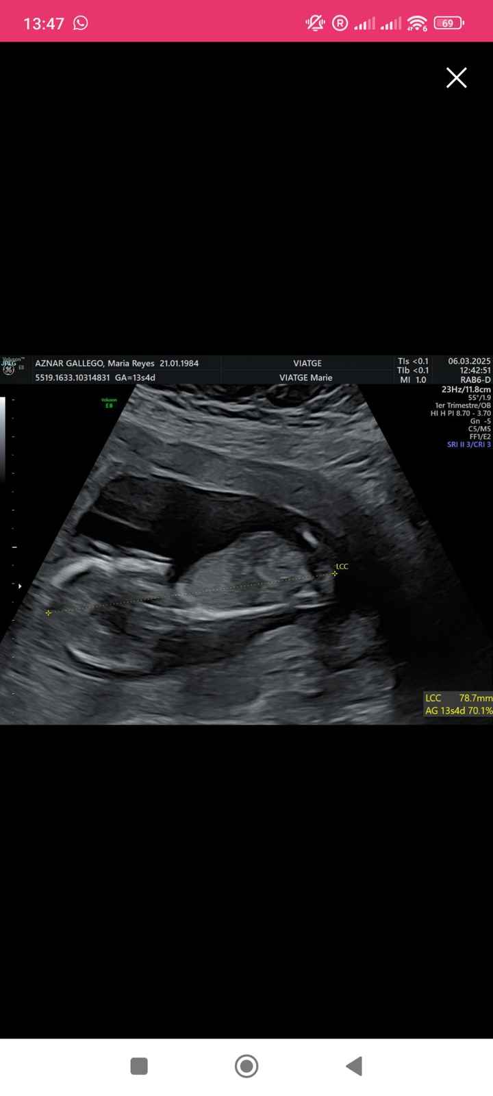 Alguien sabe identificar el sexo del bebe según el tubérculo? - 1
