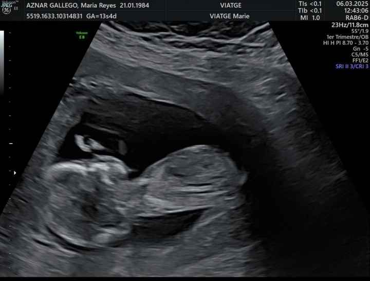 Alguien sabe identificar el sexo del bebe según el tubérculo? - 1