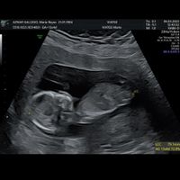 Alguien sabe identificar el sexo del bebe según el tubérculo? - 2