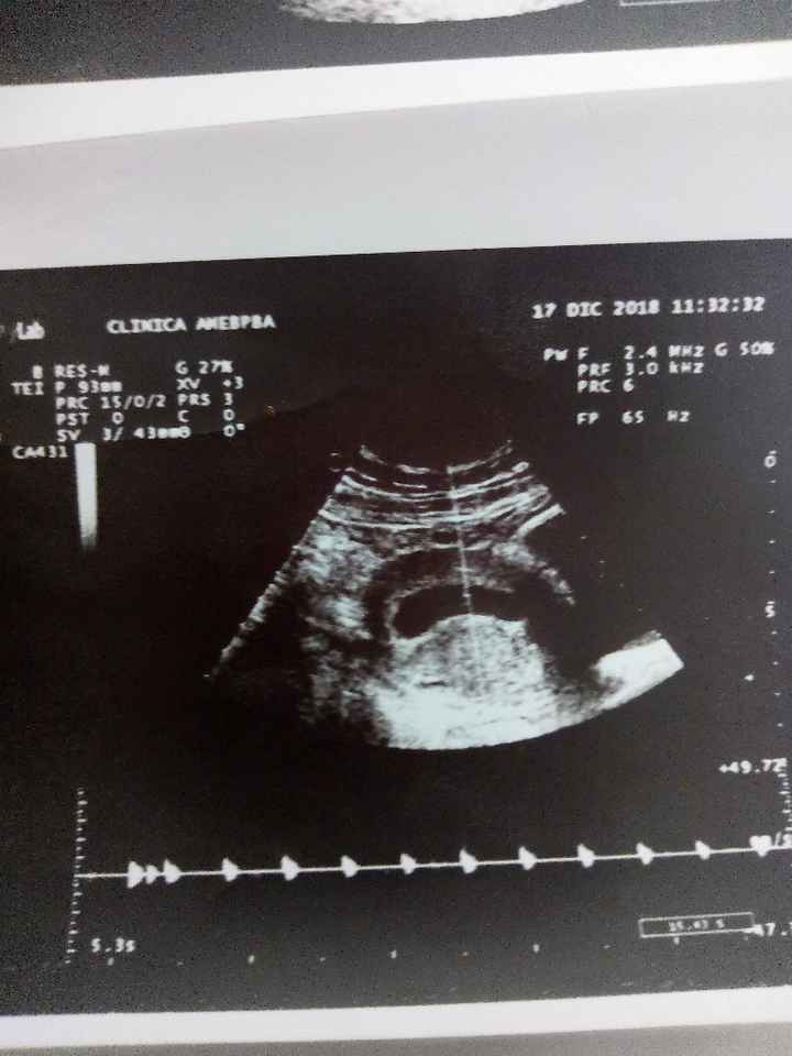 Ayuda con método ramzi: niño o niña? - 1