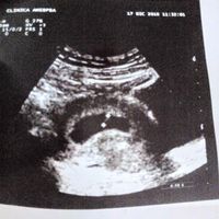 Ayuda con método ramzi: niño o niña? - 1