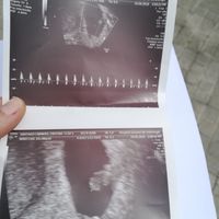 Ayuda con método ramzi: niño o niña? - 1