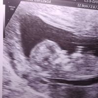 Ayuda con método ramzi: niño o niña? - 1