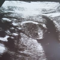 Ayuda con método ramzi: niño o niña? - 1
