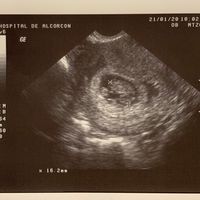 Ayuda con método ramzi: niño o niña? - 1