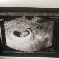Ayuda con método ramzi: niño o niña? - 1