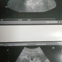 Ayuda con método ramzi: niño o niña? - 1