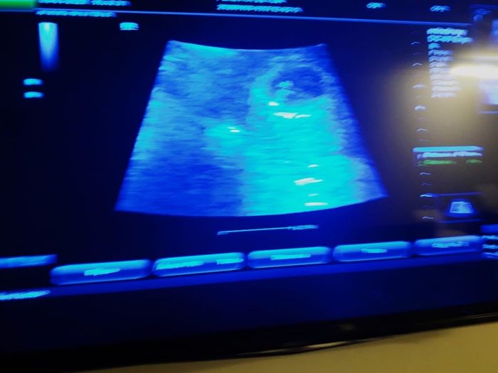 Ayuda con método ramzi: niño o niña? - 1