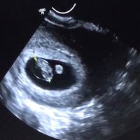 Ayuda con método ramzi: niño o niña? - 1