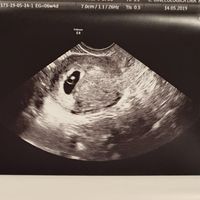 Ayuda con método ramzi: niño o niña? - 1