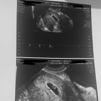 Ayuda con método ramzi: niño o niña? - 1