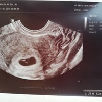 Ayuda con método ramzi: niño o niña? - 1