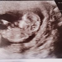 Ayuda con método ramzi: niño o niña? - 1