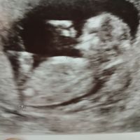 Ayuda con método ramzi: niño o niña? - 2