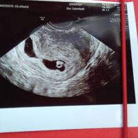 Ayuda con método ramzi: niño o niña? - 1