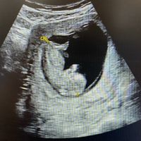 Ayuda con método ramzi: niño o niña? - 1