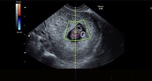 Ayuda con método ramzi: niño o niña? - 1