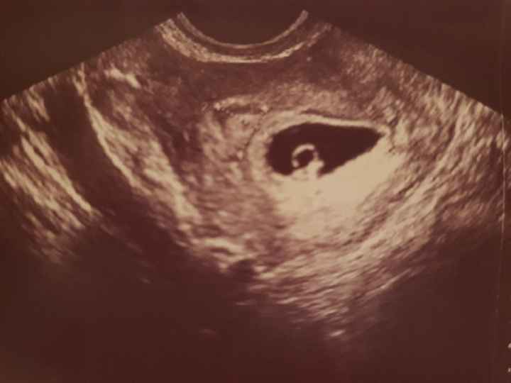 Ayuda con método ramzi: niño o niña? - 1