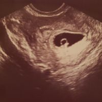 Ayuda con método ramzi: niño o niña? - 1
