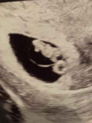Ayuda con método ramzi: niño o niña? - 1
