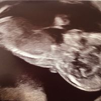 Ayuda con método ramzi: niño o niña? - 1