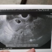 Eco de 6semanas + 5días vaginal, niño o niña? jiji