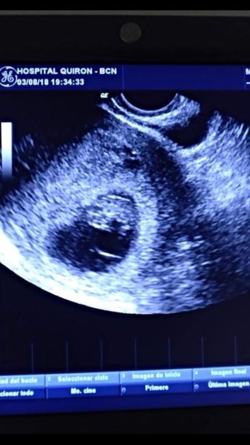Ayuda con método ramzi: niño o niña? - 1