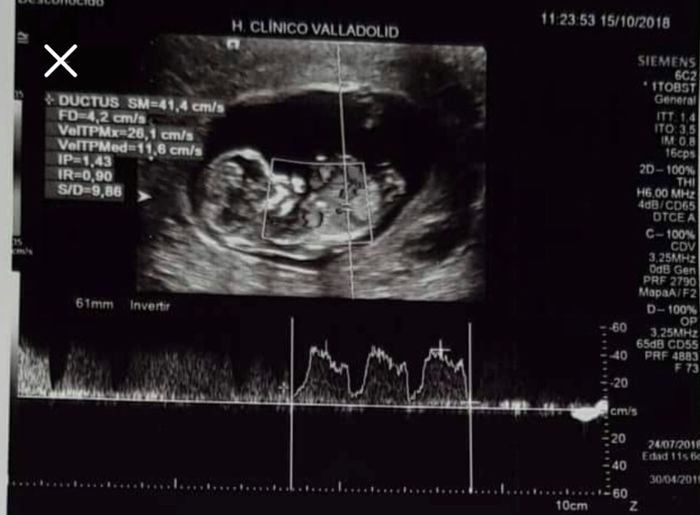 Ayuda con método ramzi: niño o niña? 1