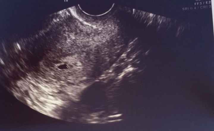 Ayuda con método ramzi: niño o niña? - 1