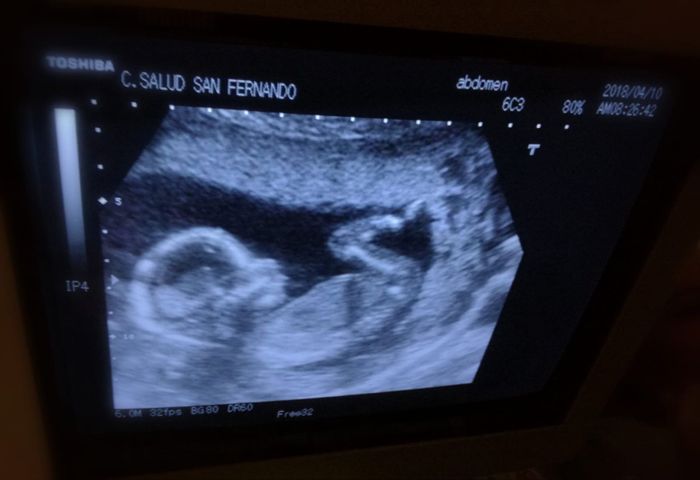 Ayuda con método ramzi: niño o niña? - 1
