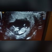 Ayuda con método ramzi: niño o niña? - 1