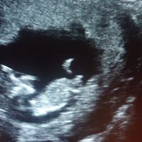 Ayuda con método ramzi: niño o niña? - 1