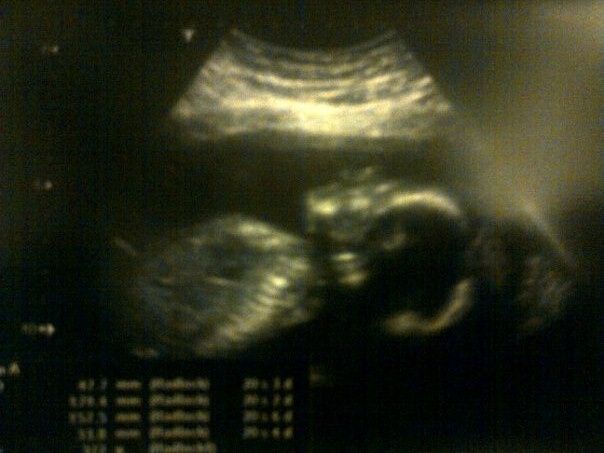 20 Semanas