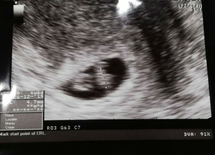 Ayuda con método ramzi: niño o niña? - 1