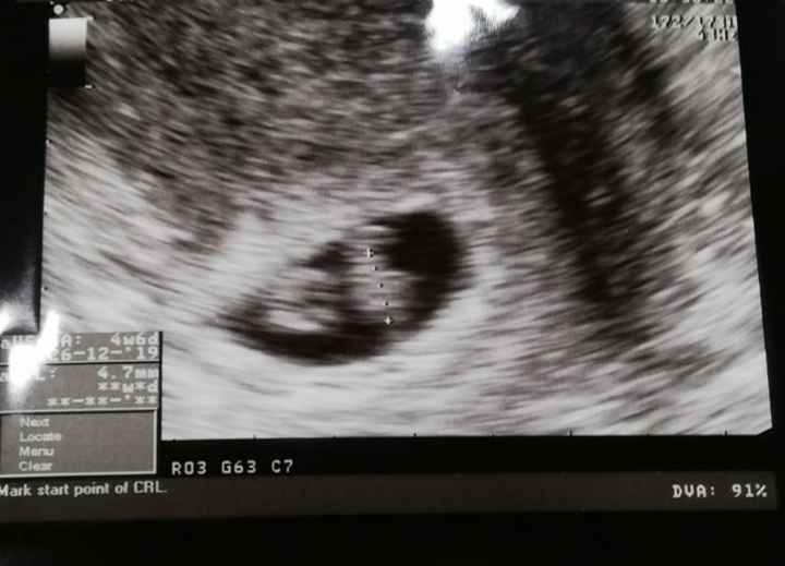 Ayuda con método ramzi: niño o niña? - 1