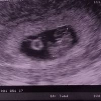 Ayuda con método ramzi: niño o niña? - 1