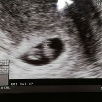 Ayuda con método ramzi: niño o niña? - 1